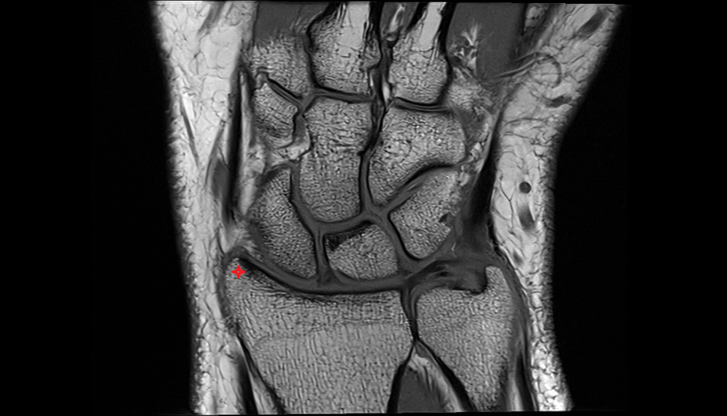 Radial styloid process coronal cross sectional anatomy 3T MRI AI enhanced radiology image-img-00000-00000