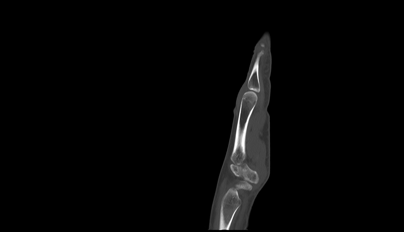 Radial styloid process ct sag image