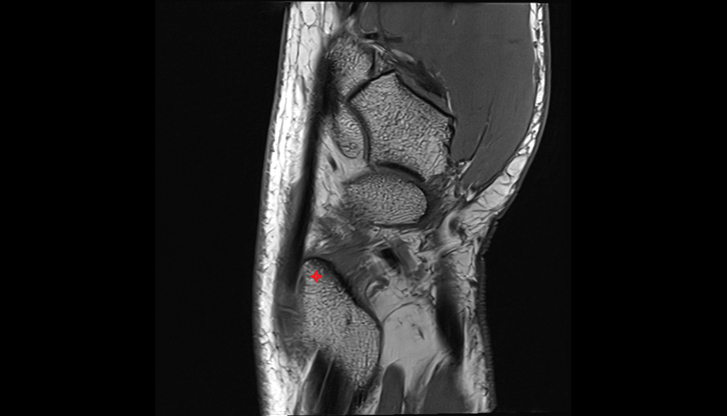 Radial styloid process sag cross sectional anatomy 3T MRI AI enhanced radiology image-img-00000-00000