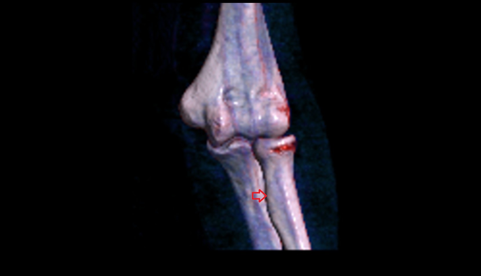 Radial tuberosity 3d vrt image