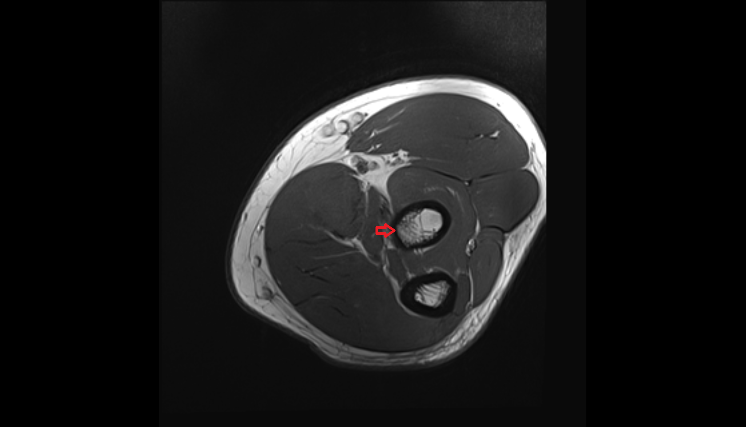 Radial tuberosity axial  cross sectional anatomy 3T MRI AI enhanced radiology image -img-00000-00000