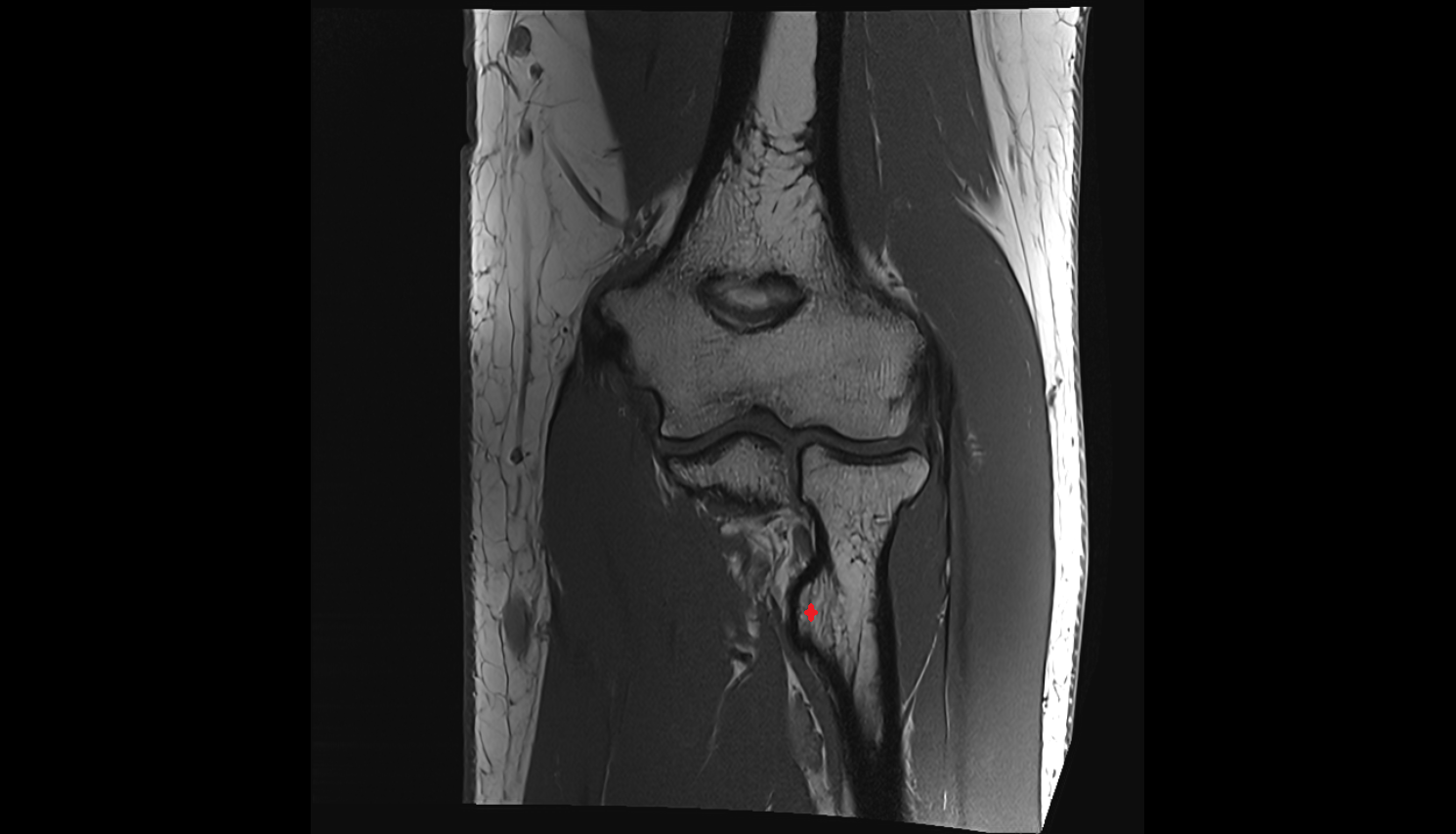 Radial tuberosity coronal  cross sectional anatomy 3T MRI AI enhanced radiology image -img-00000-00000