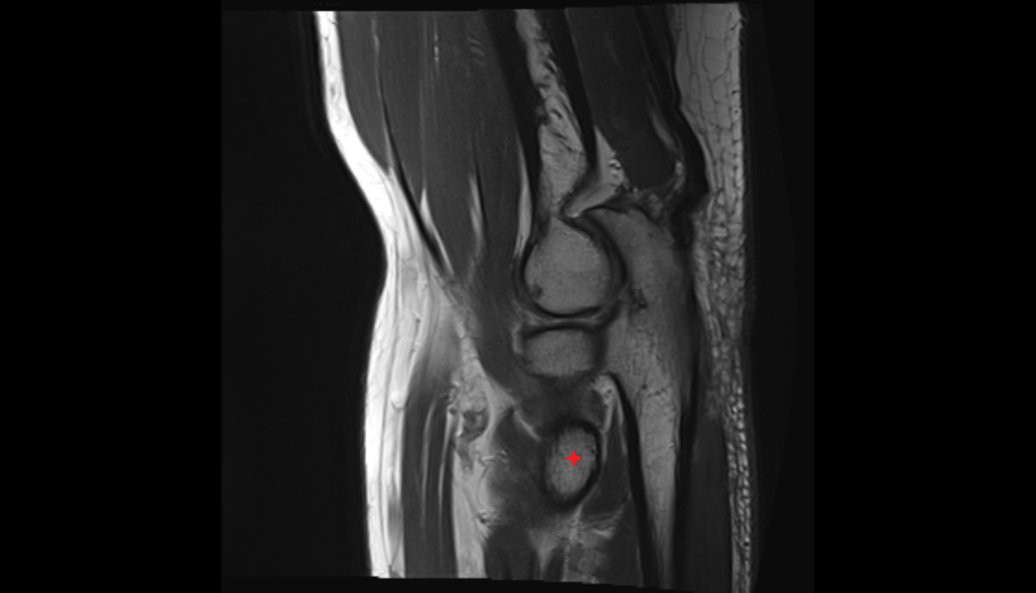 Radial tuberosity sag  cross sectional anatomy 3T MRI AI enhanced radiology image -img-00000-00000