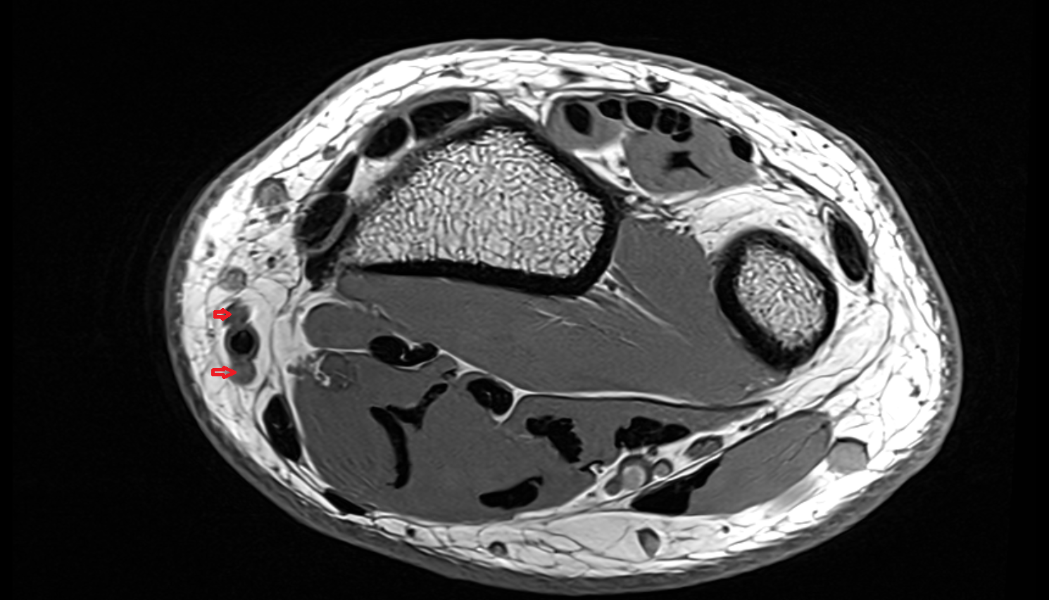 Radial veins  axial cross sectional anatomy 3T MRI AI enhanced radiology image -img-00000-00000