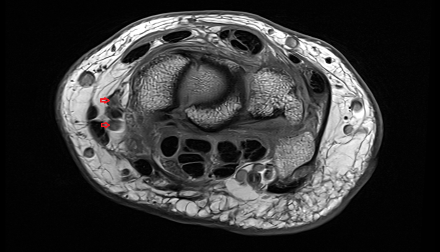 Radial veins  axial cross sectional anatomy 3T MRI AI enhanced radiology image -img-00000-00000_00001