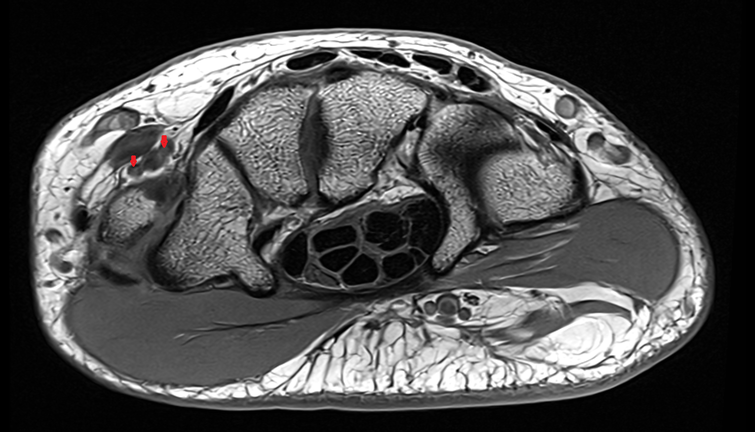 Radial veins  axial cross sectional anatomy 3T MRI AI enhanced radiology image -img-00000-00000_00002