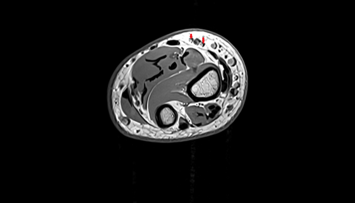 Radial veins  axial cross sectional anatomy 3T MRI AI enhanced radiology image -img-00000-00000_00003