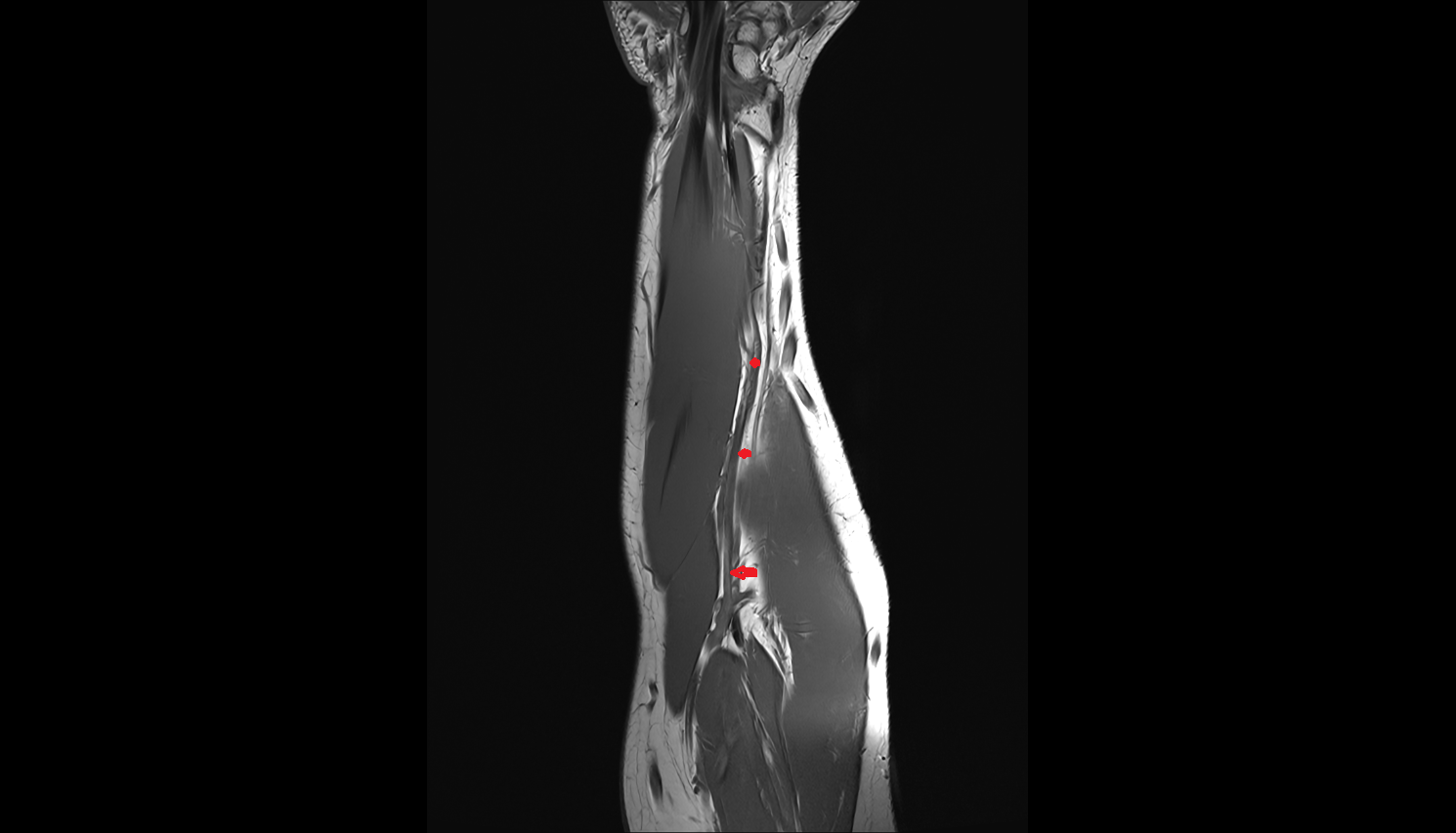 Radial veins coronal cross sectional anatomy 3T MRI AI enhanced radiology image -img-00000-00000