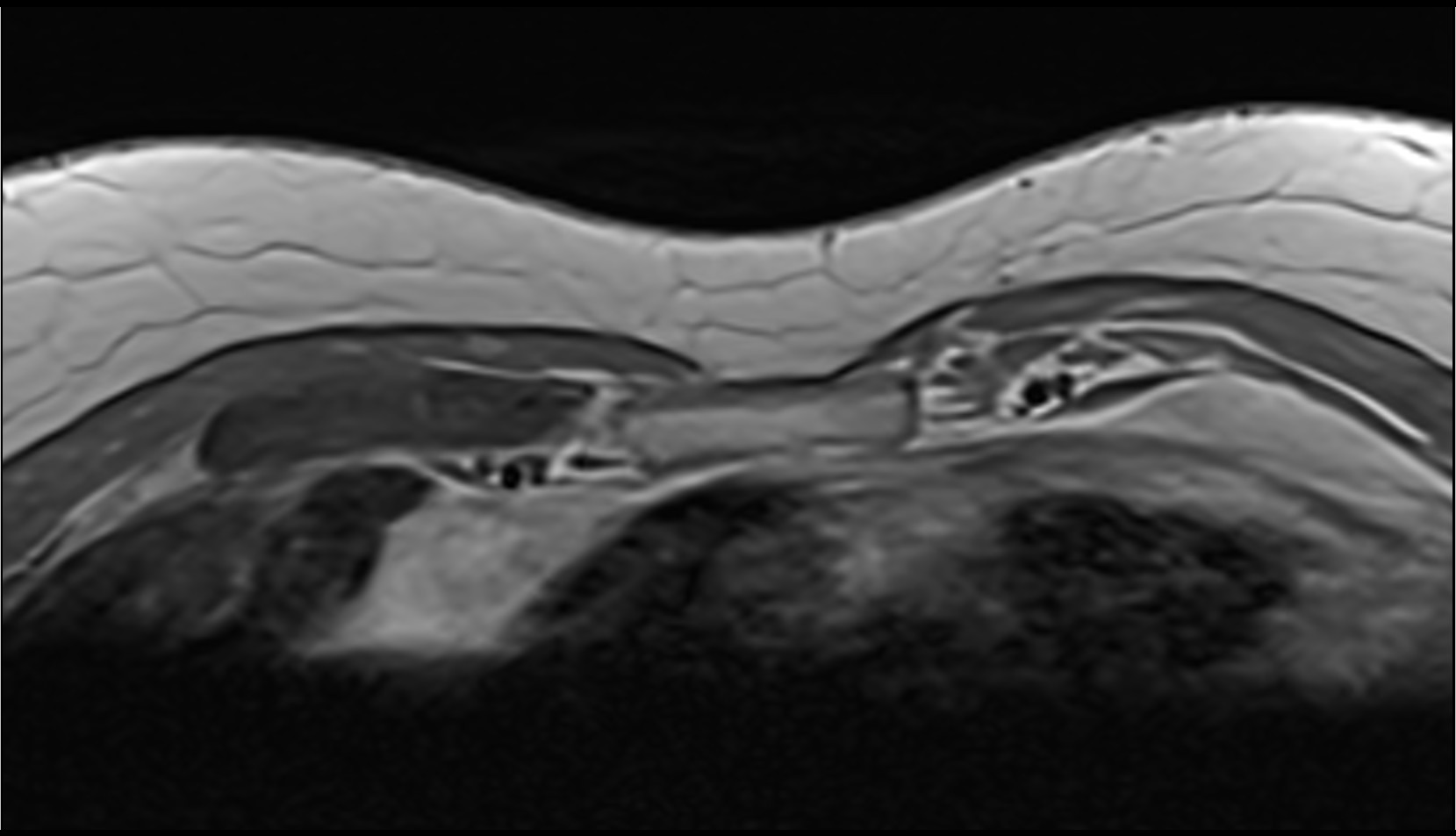 Radiate sternocostal ligament mri axial image