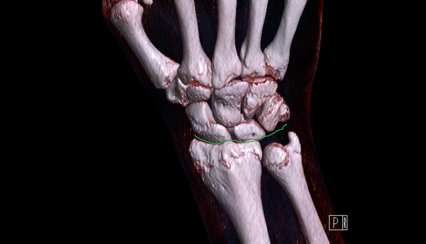 Radiocarpal joint CT 3D VRT image -img-00000-00000