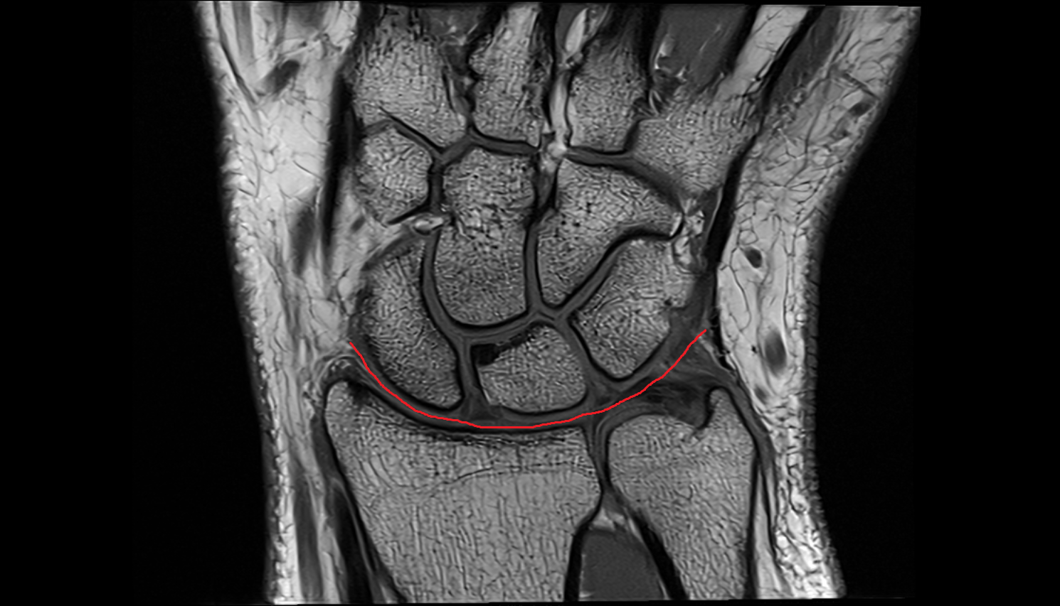 Radiocarpal joint coronal cross sectional anatomy 3T MRI AI enhanced radiology image-img-00000-00000