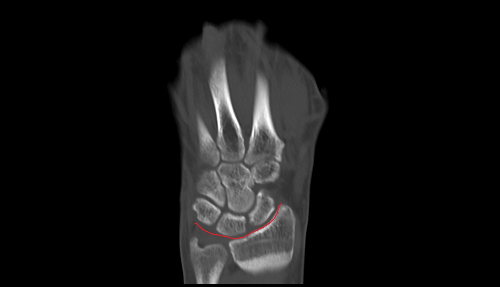 Radiocarpal joint ct coronal image