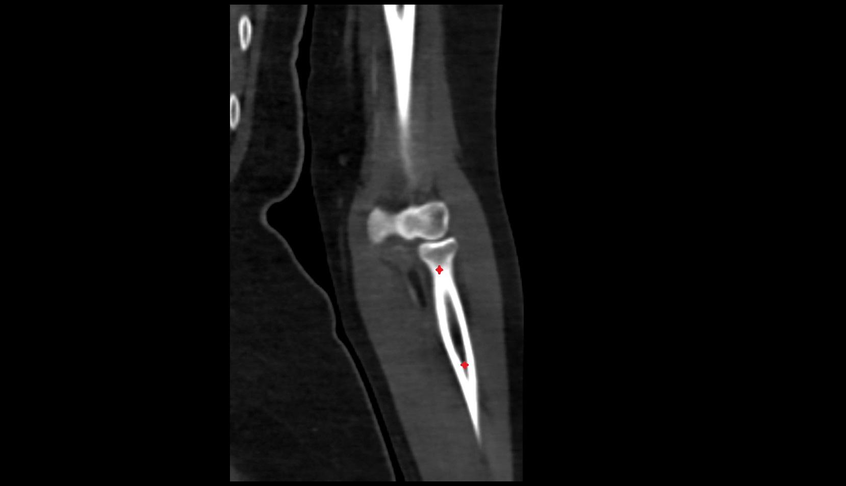Radius BONE CT IMAGE