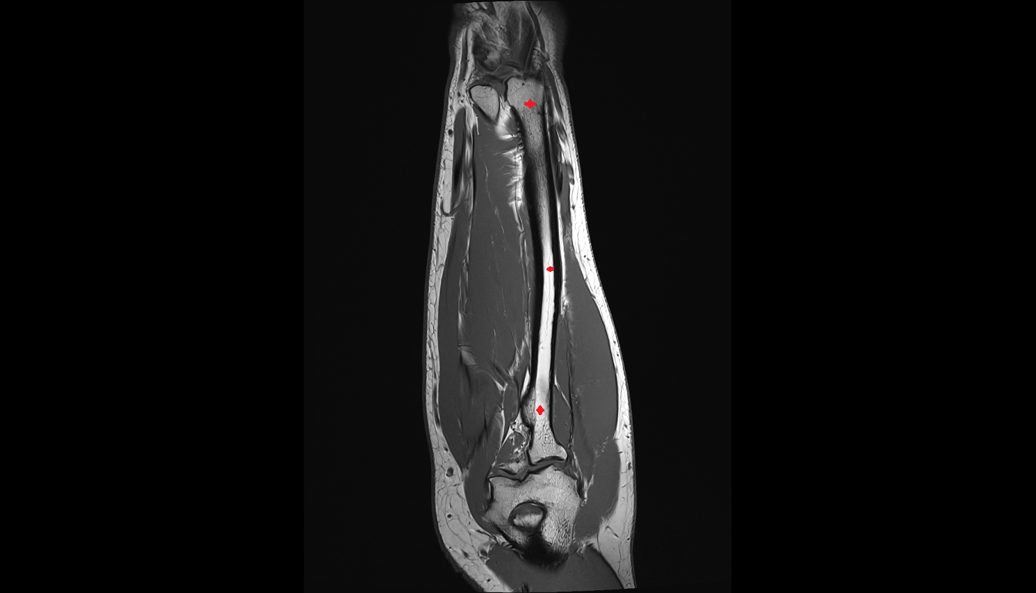 Radius bone coronal cross sectional anatomy 3T MRI AI enhanced radiology image -img-00000-00000