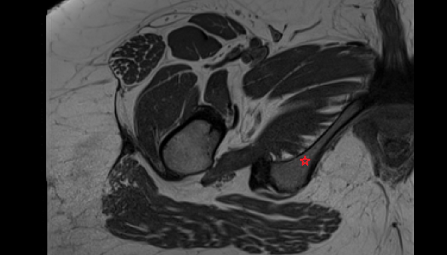 Ramus of ischium  MRI  axial  anatomy  image-img-00000-00000