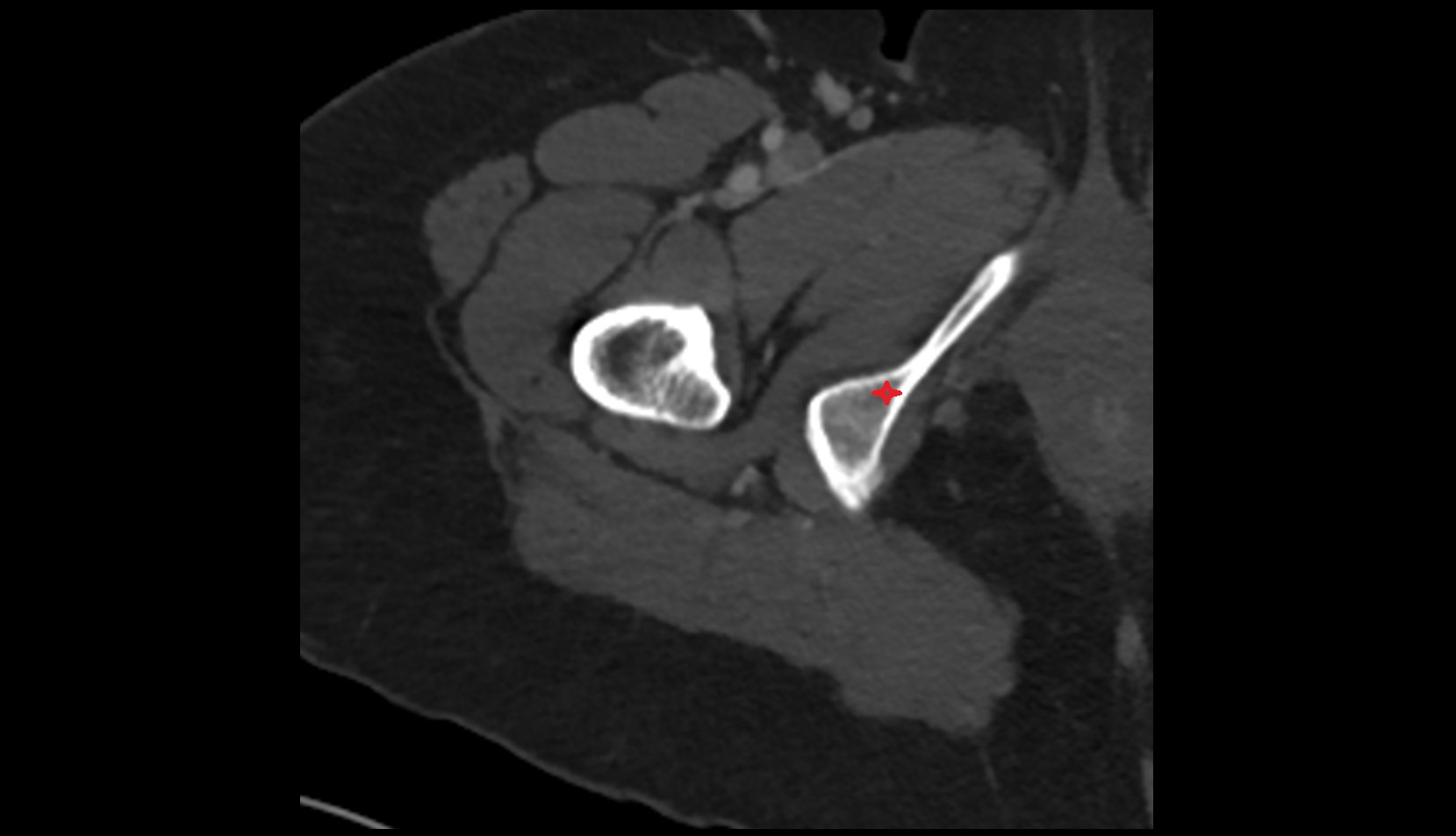 Ramus of ischium ct axial
