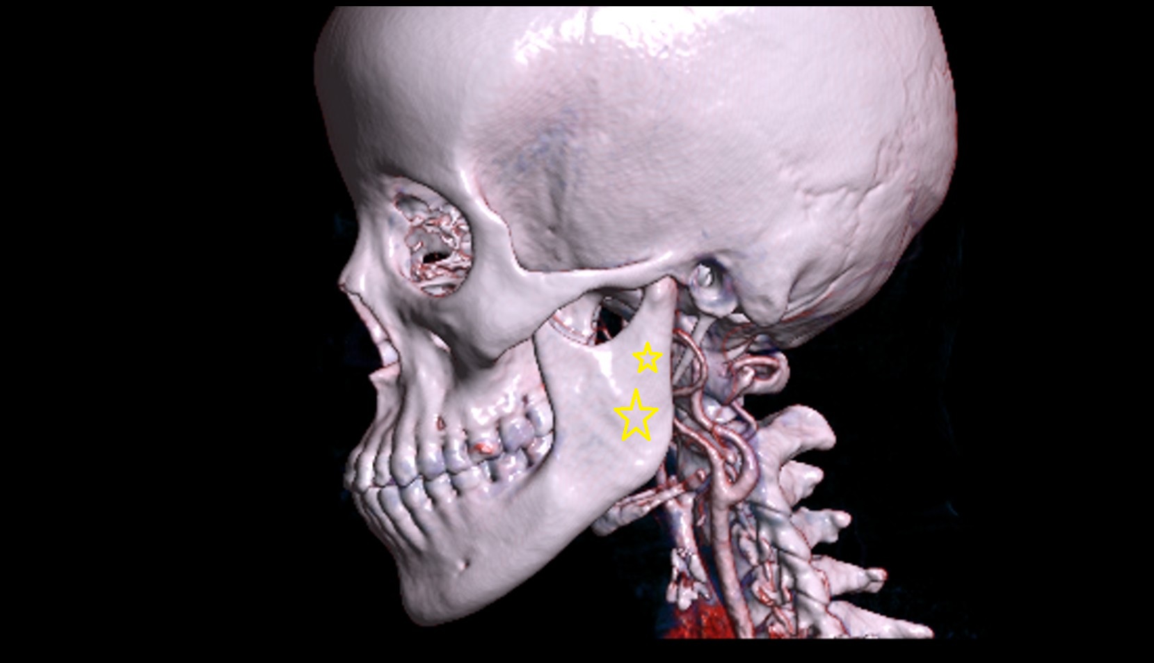 Ramus of mandible 3D