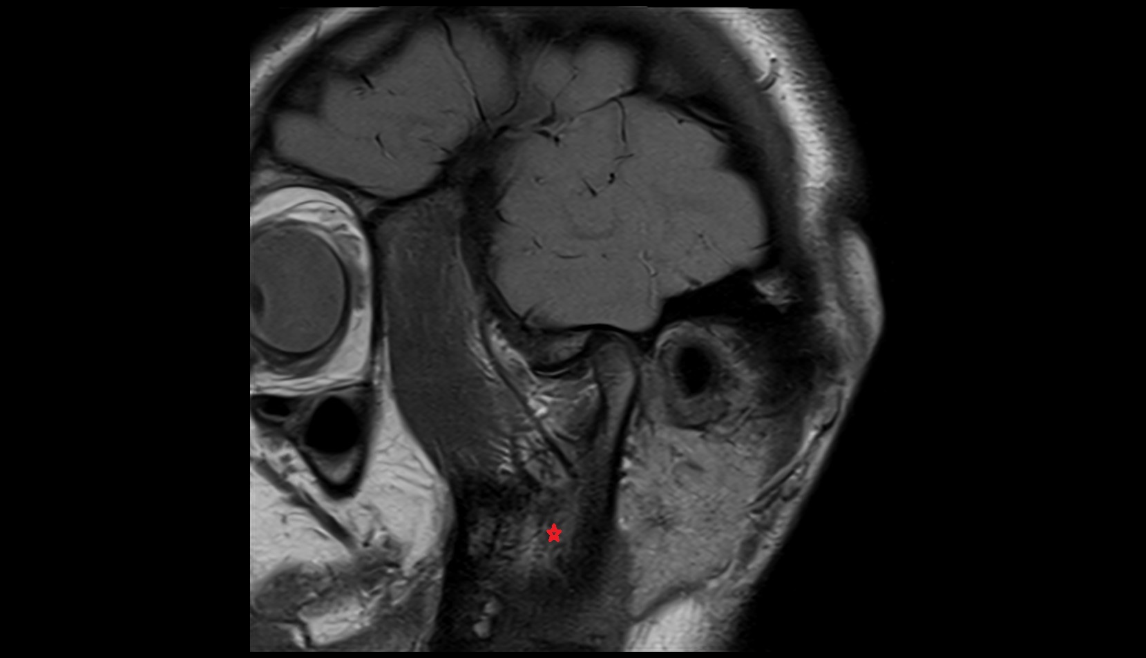 Ramus of mandible mri