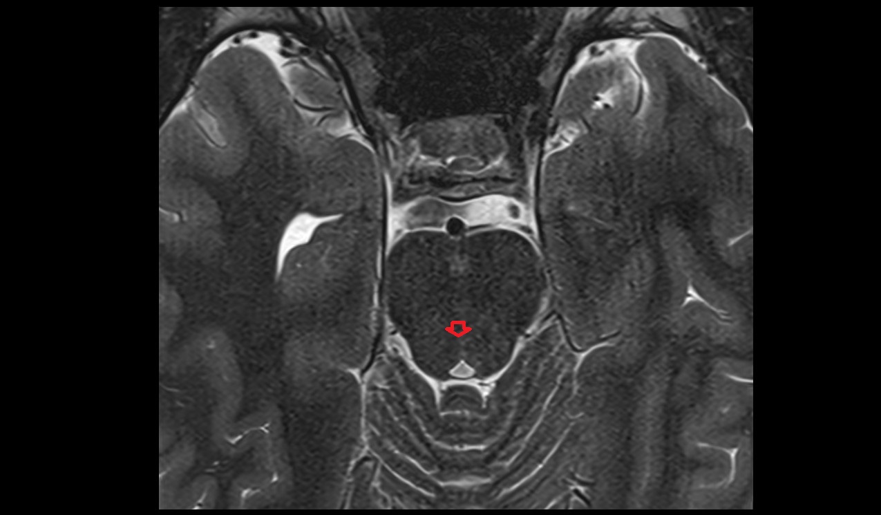 Raphe of pons mri 3t axial image