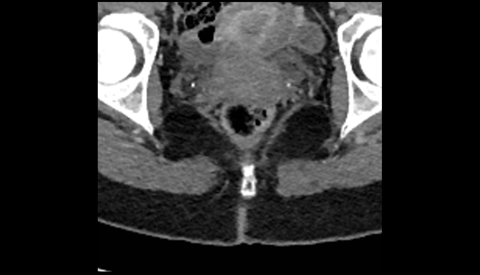 Rectococcygeal muscle CT AXIAL IMAGE