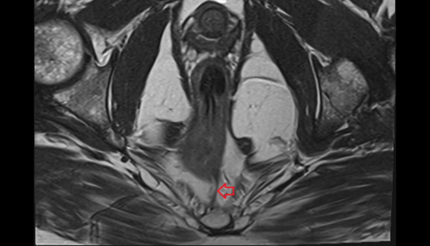 Rectococcygeal muscle  MRI  AXIAL anatomy  image-img-00000-00000