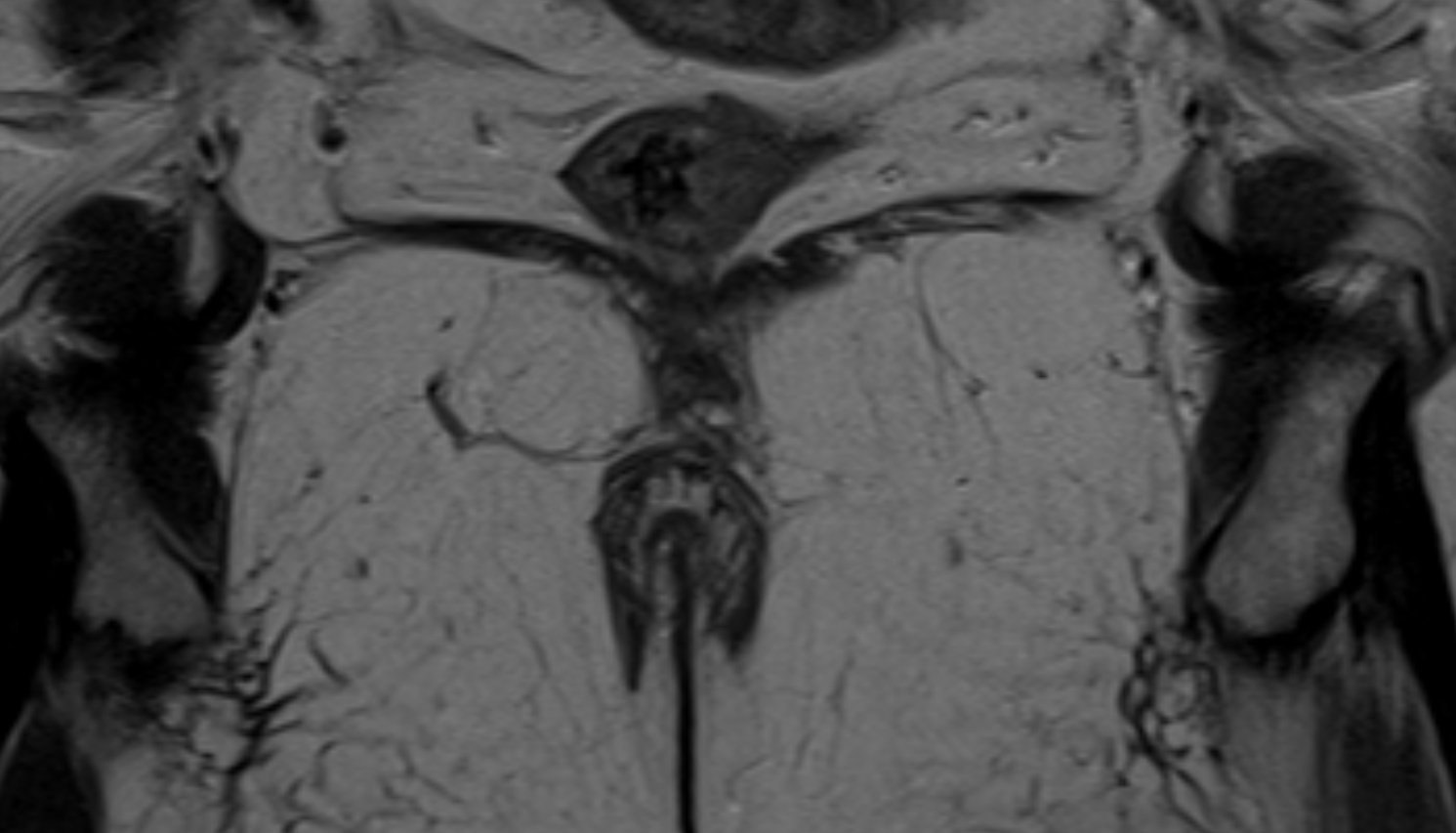 Rectococcygeal muscle  MRI Coronal anatomy  image-img-00000-00000