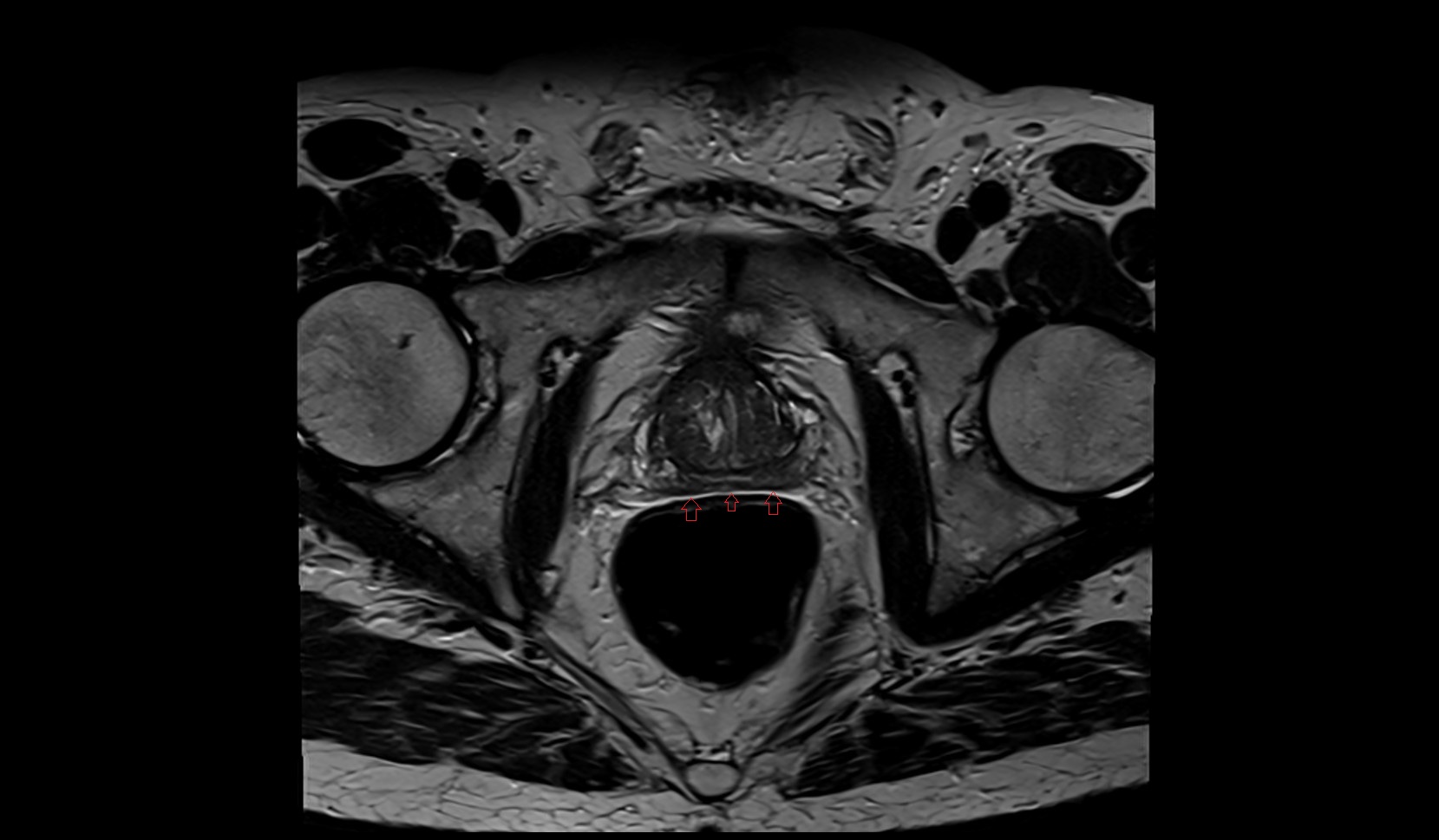 Rectoprostatic (Denonvilliers’) fascia