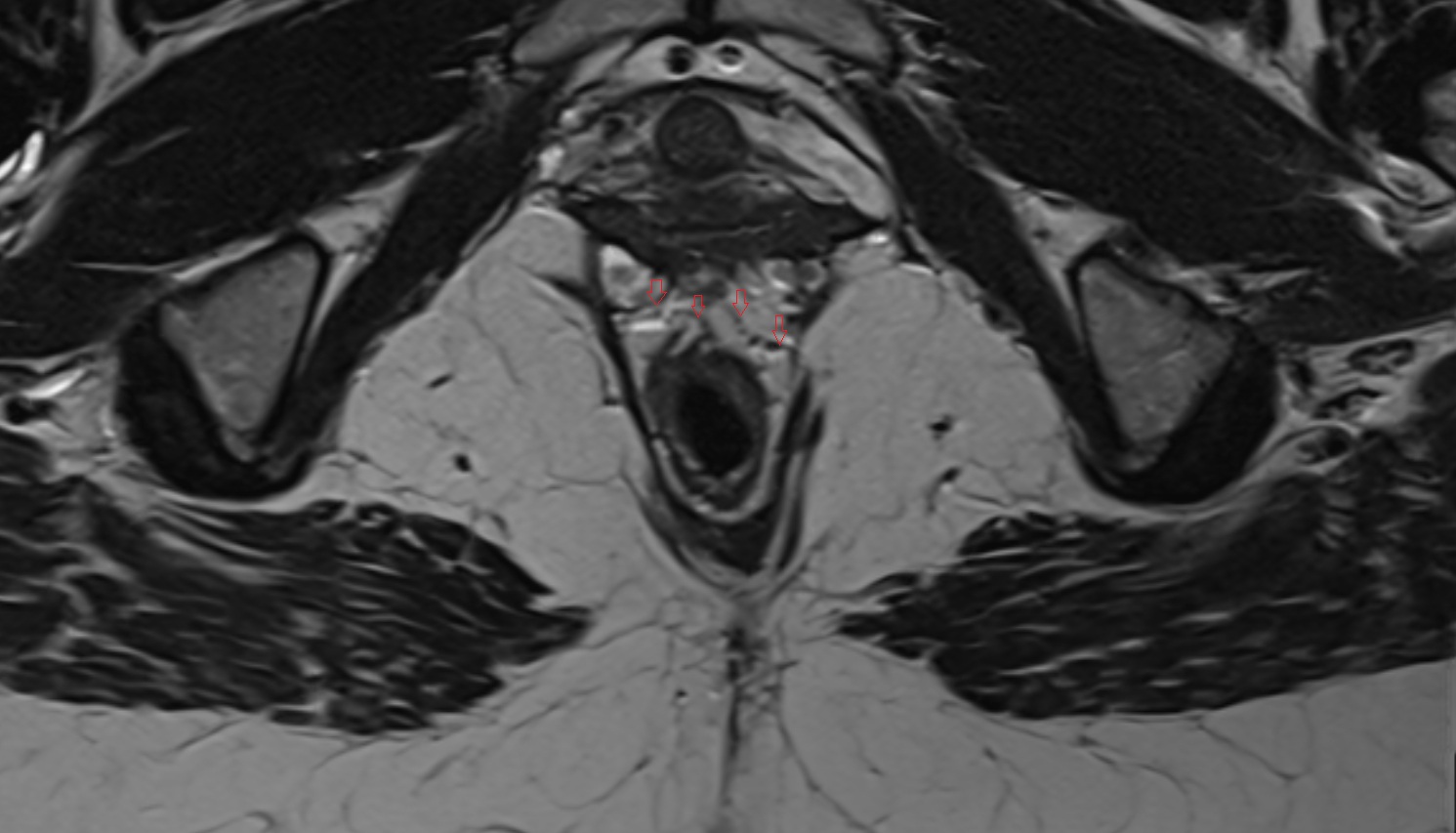 Rectovaginal Septum   MRI axial  image  image  MRI coronal  anatomy  image