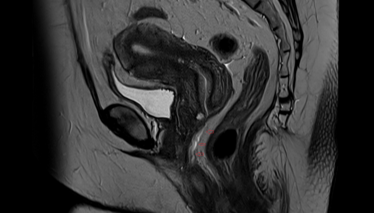 Rectovaginal Septum (rectovaginal fascia)  MRI sagittal image