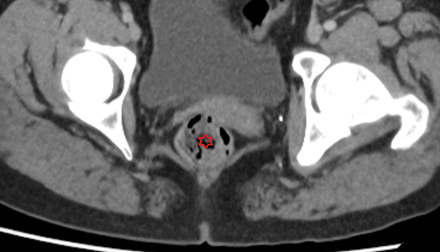 Rectum CT axial  anatomy  image-img-00000-00000