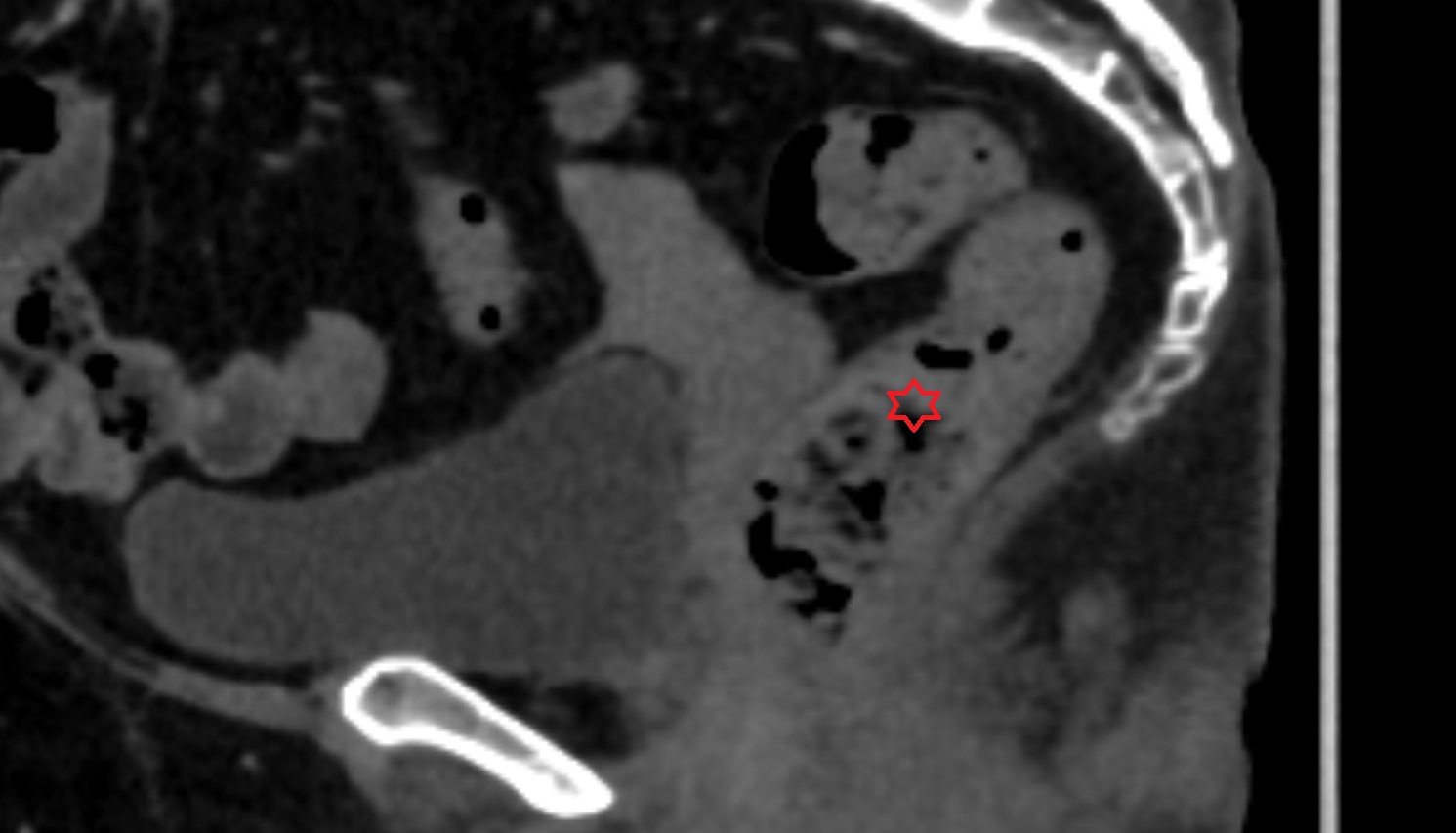 Rectum CT sagittal  anatomy  image-img-00000-00000