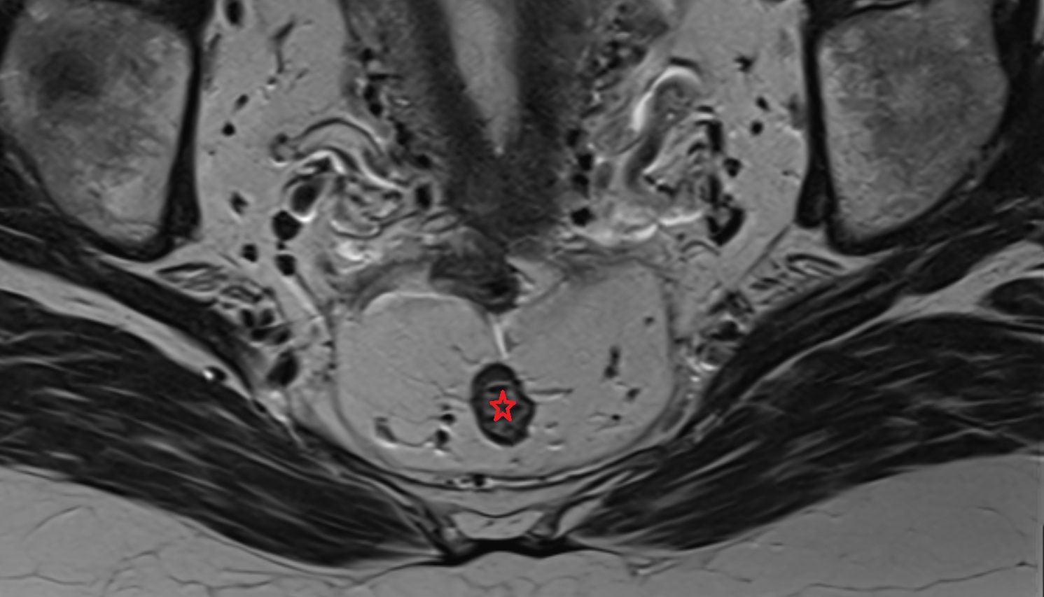 Rectum  MRI axial  anatomy  image-img-00000-00000