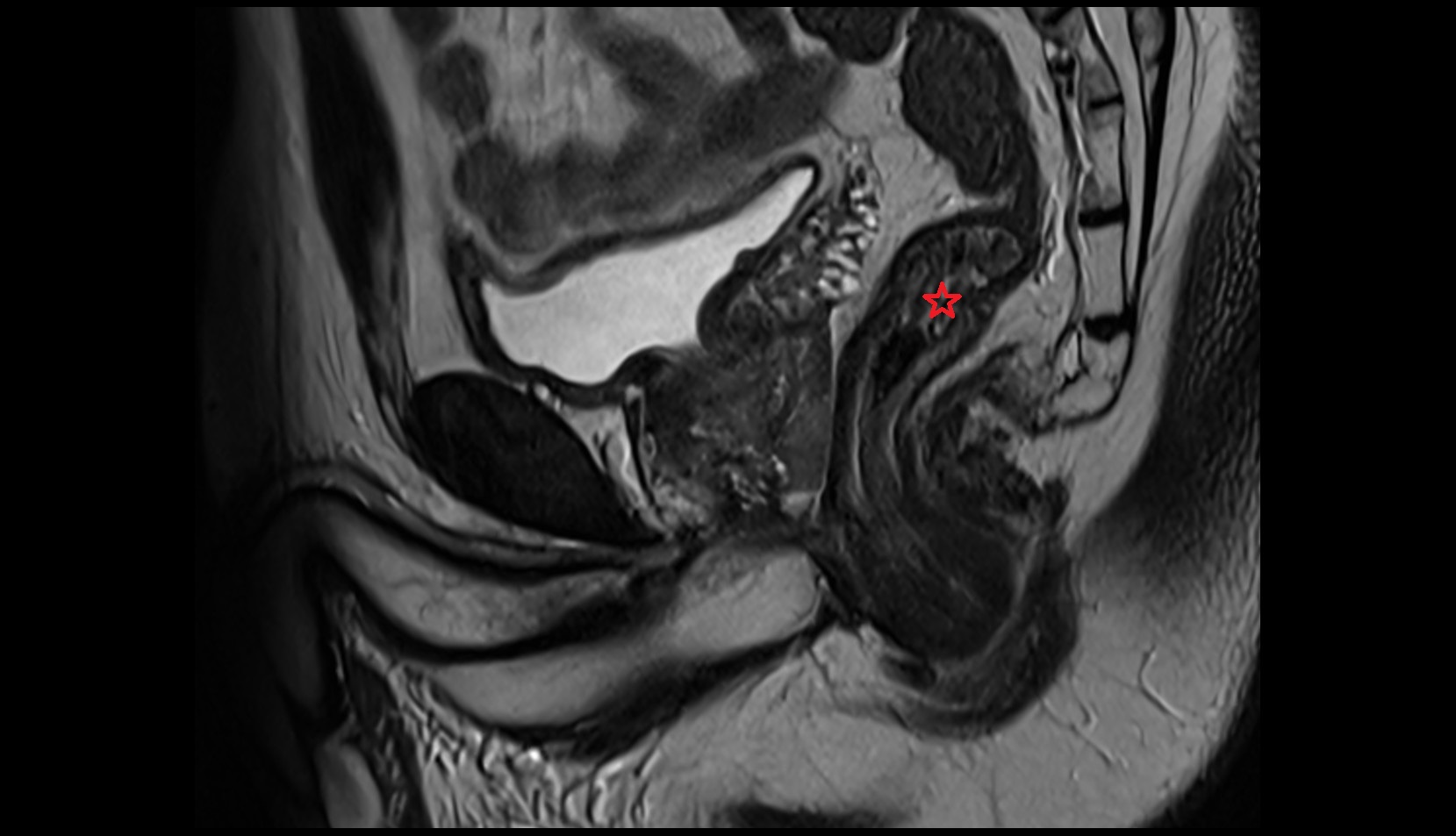 Rectum  MRI sagittal   anatomy  image-img-00000-00000