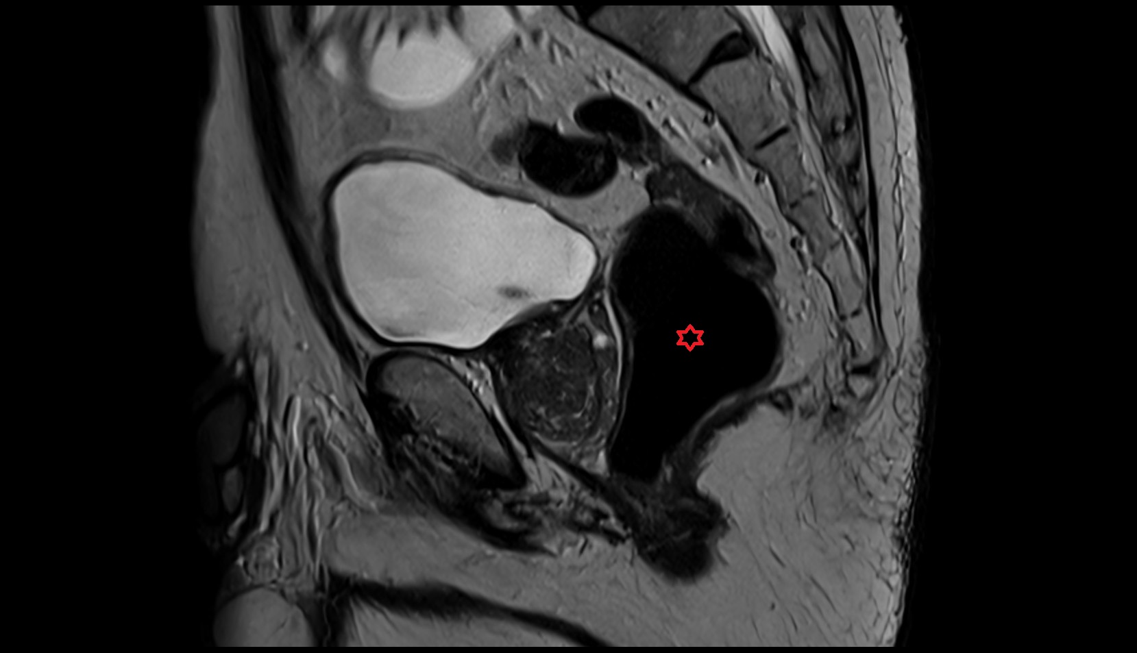 Rectum  MRI sagittal   anatomy  image 1