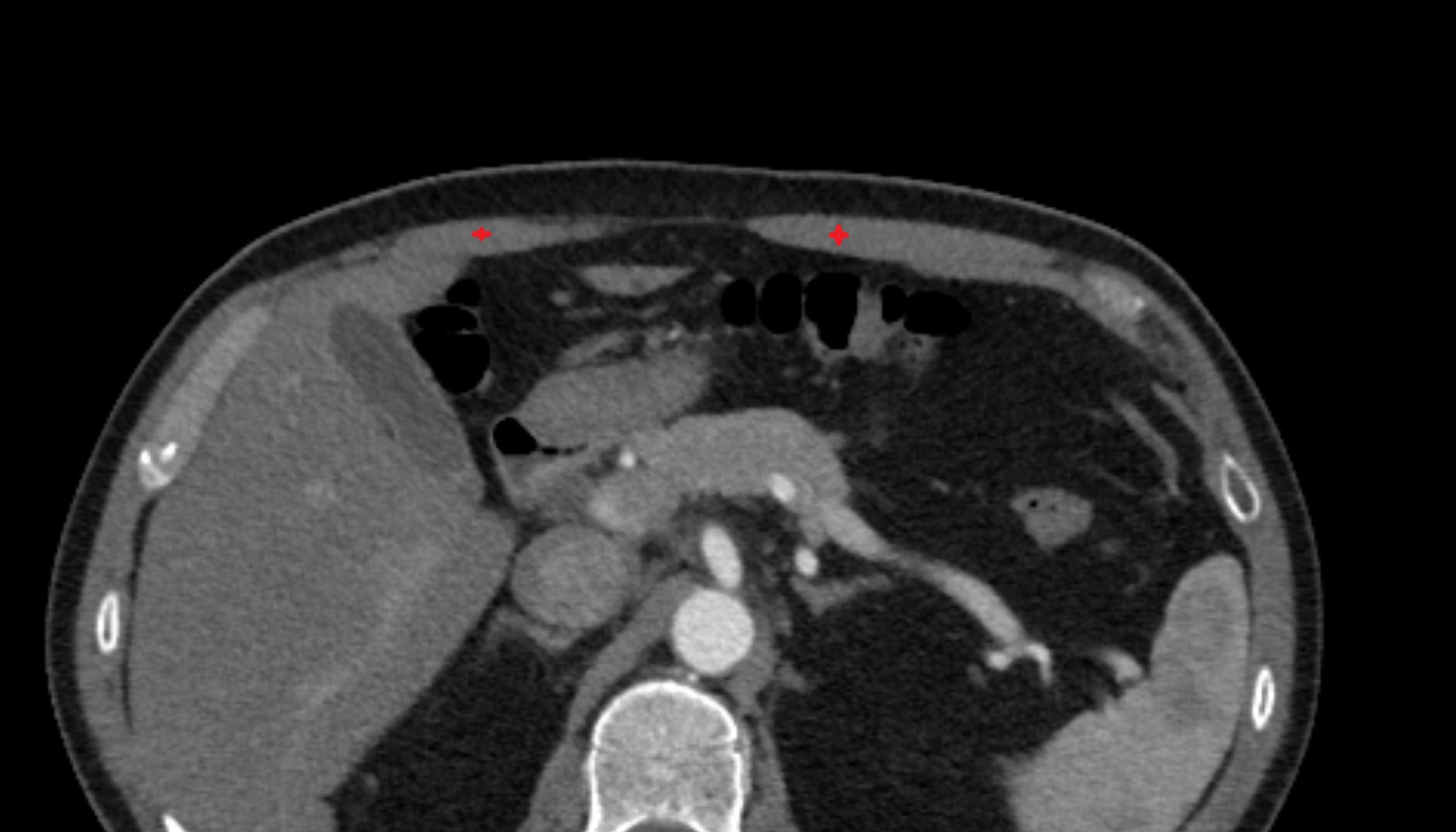 Rectus abdominis  muscle  anatomy CT axial  image -img-00000-00000