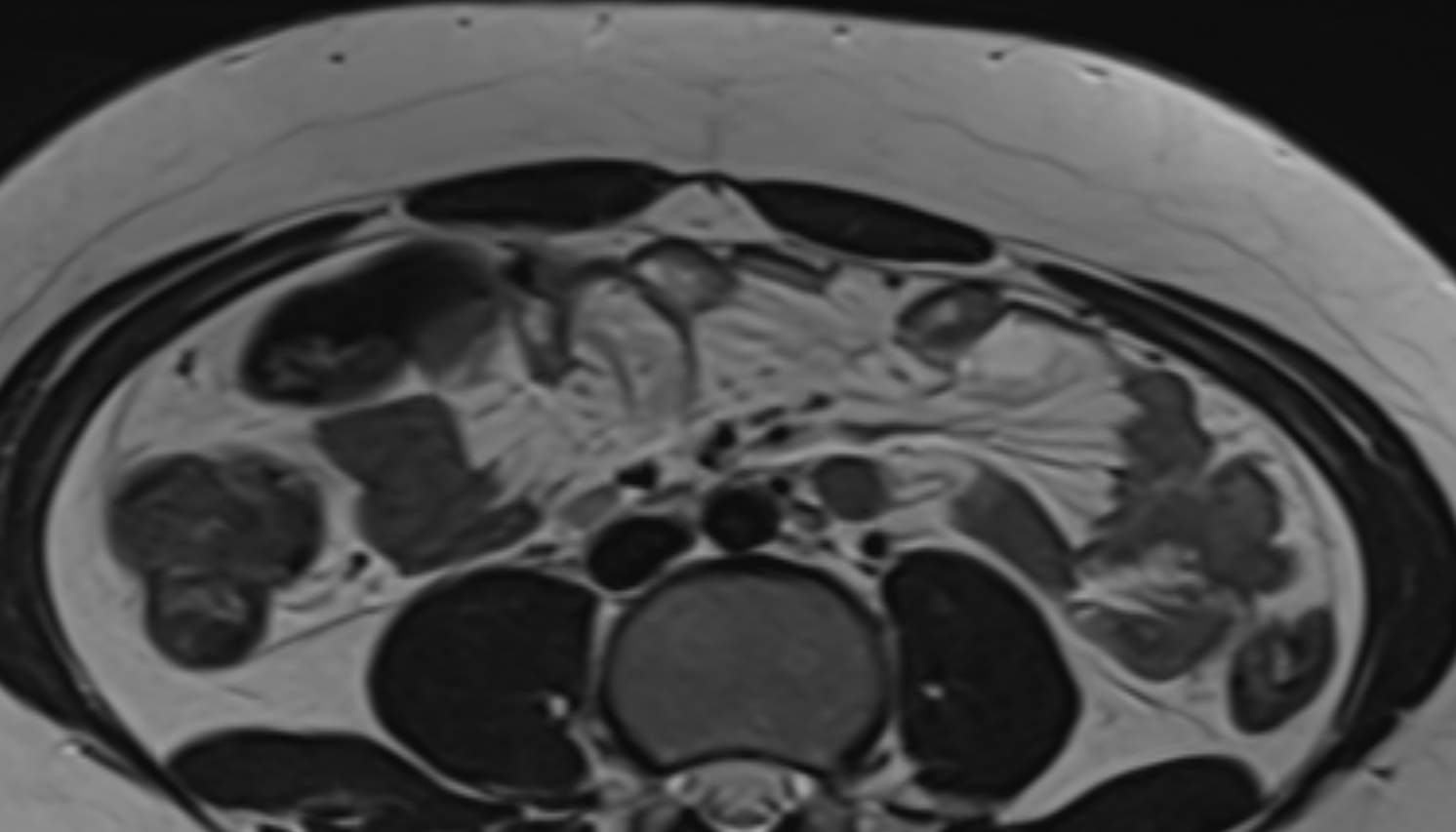 Rectus abdominis  muscle  anatomy MRI axial  image -img-00000-00000