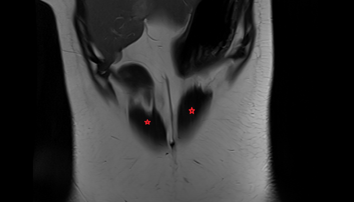 Rectus abdominis  muscle  anatomy MRI coronal  image -img-00000-00000