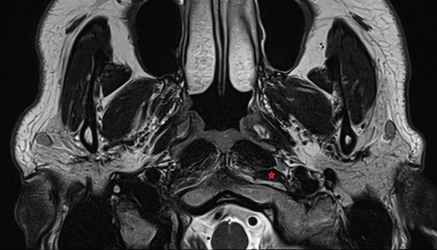 Rectus capitis anterior muscle mri axial image 1 -img-00000-00000