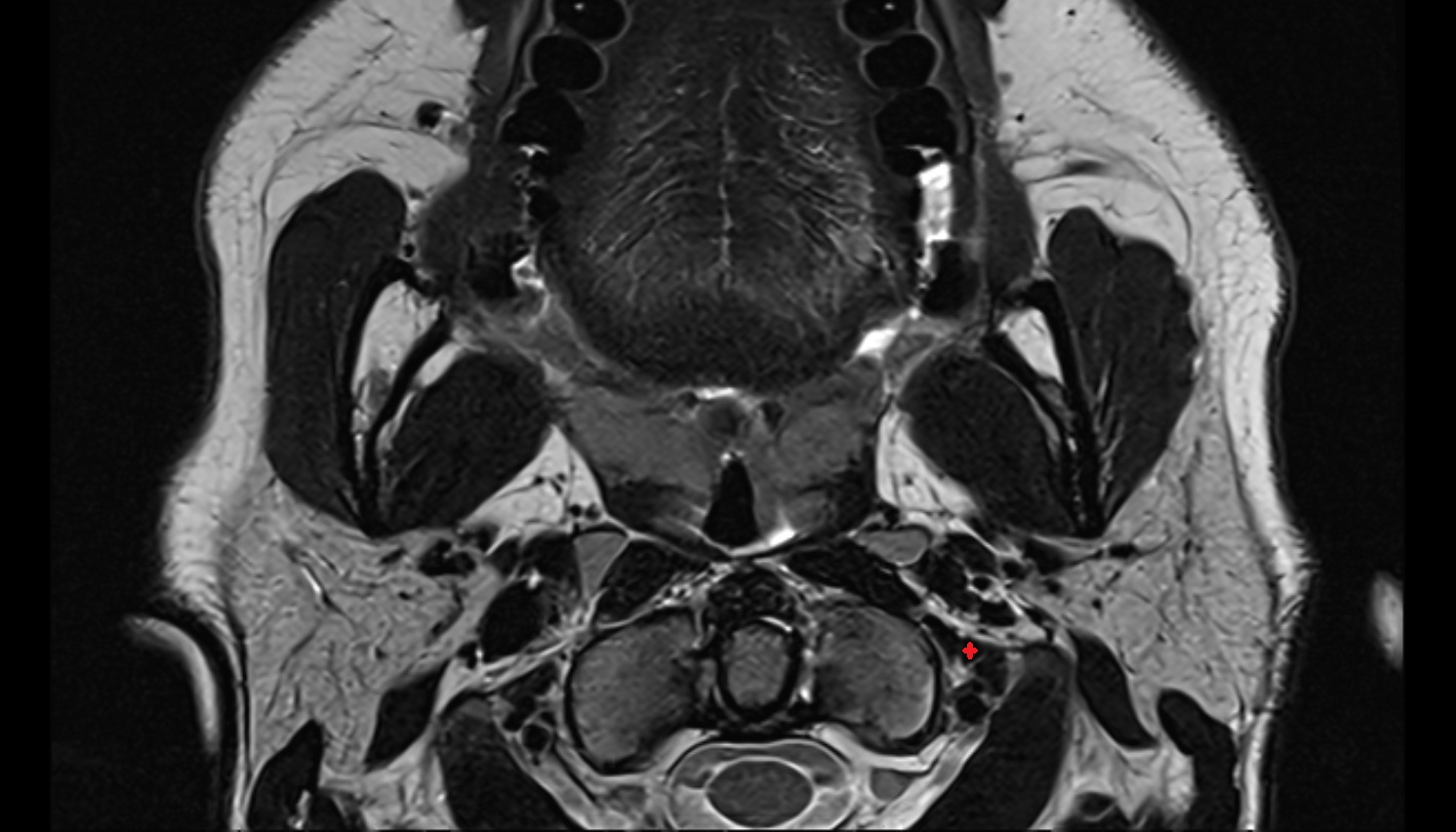 Rectus capitis lateralis muscle mri axial image -img-00000-00000