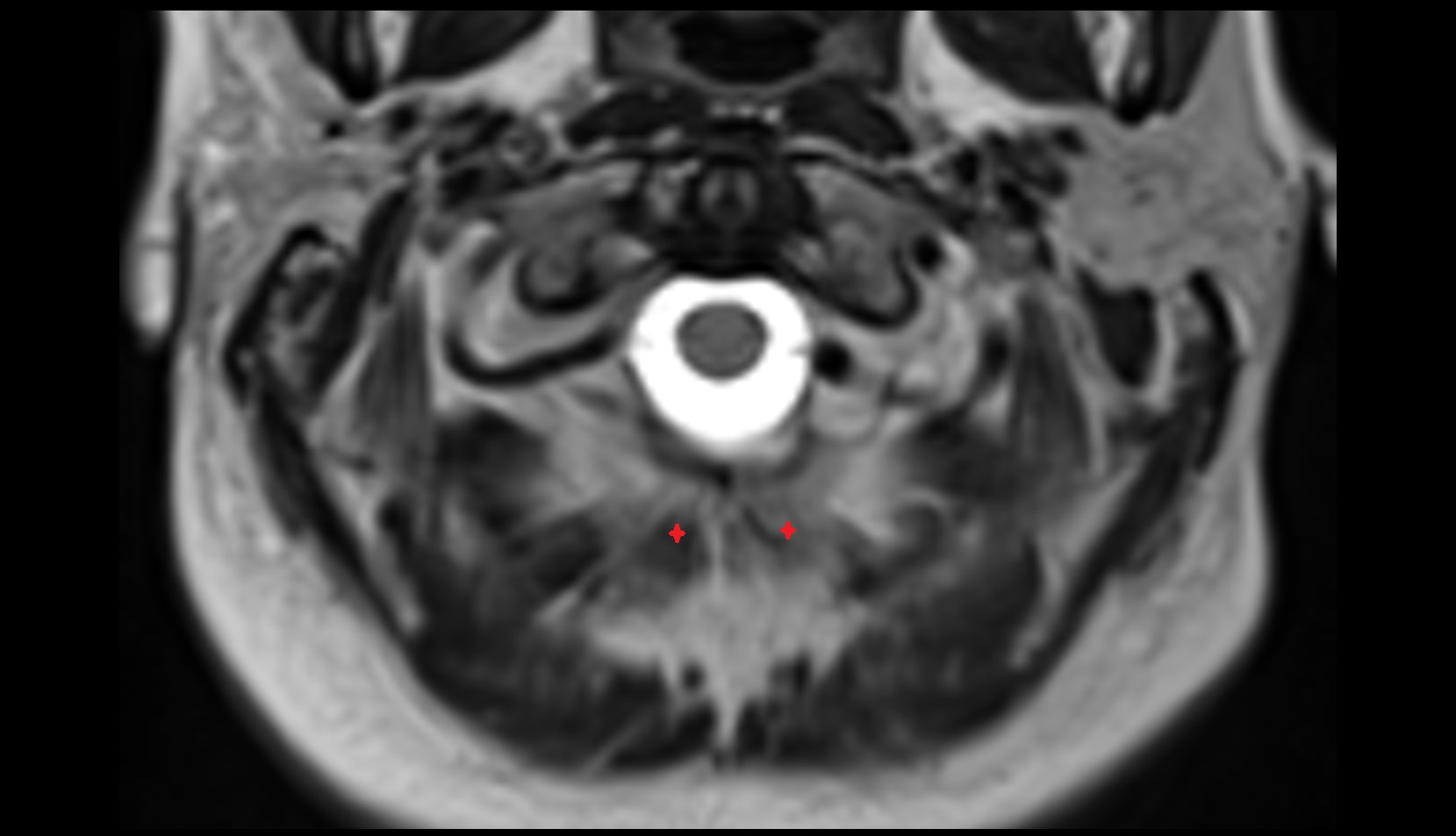 Rectus capitis posterior minor muscle MRI axial image