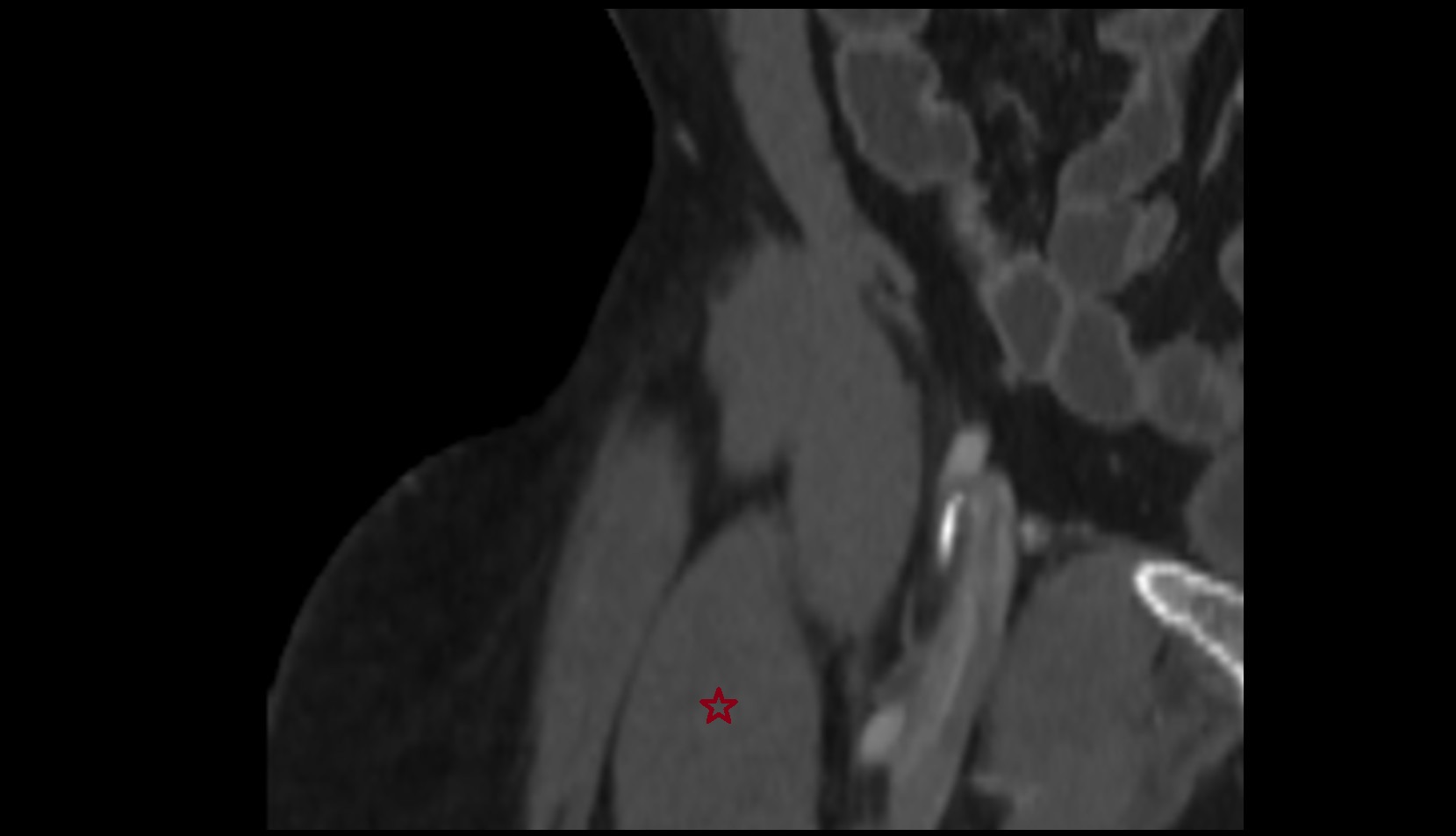 Rectus femoris muscle CORONAL