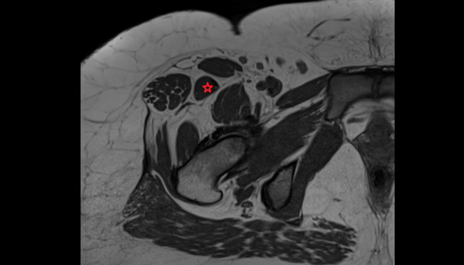 Rectus femoris muscle MRI  axial   anatomy  image-img-00000-00000 - Copy