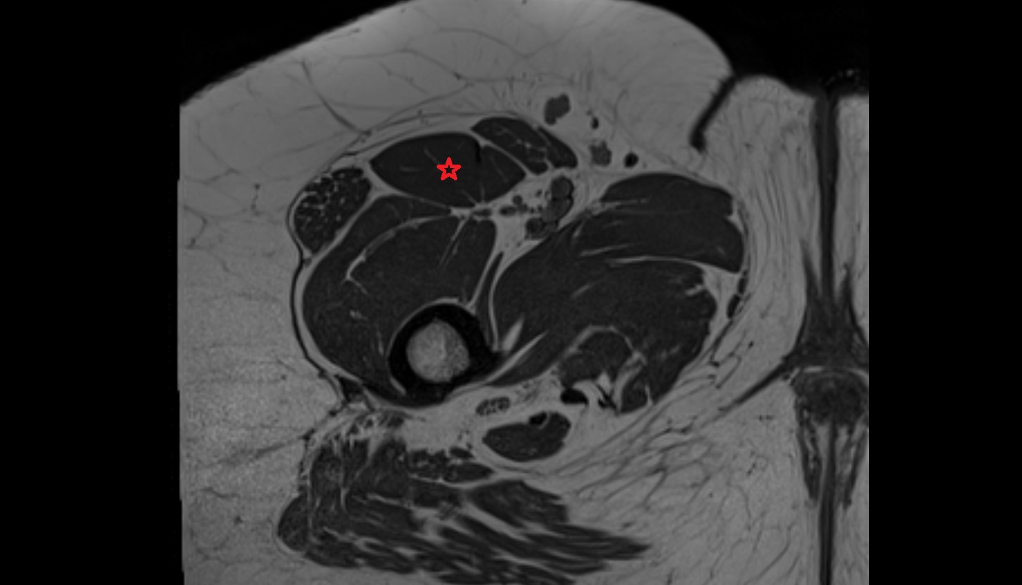 Rectus femoris muscle MRI  axial   anatomy  image-img-00000-00000_00001 - Copy