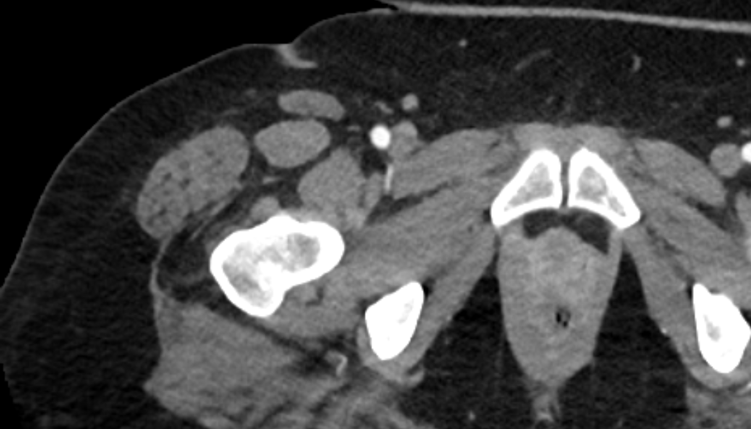 Rectus femoris muscle ct axial   anatomy  image-img-00000-00000