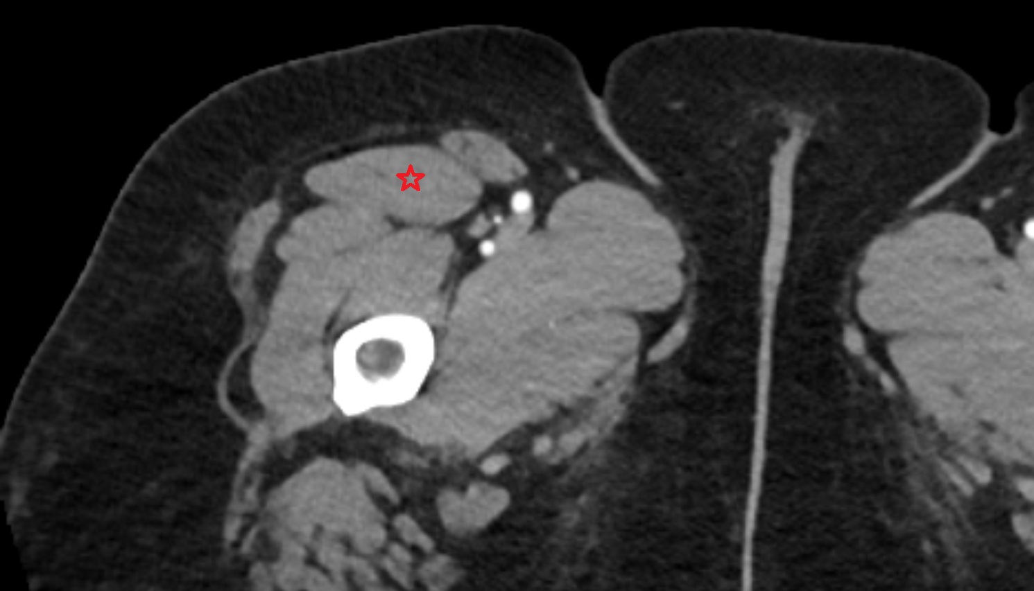 Rectus femoris muscle ct axial   anatomy  image-img-00000-00000_00001