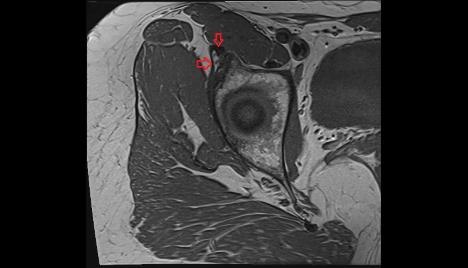 Rectus femoris tendon (Proximal tendon of rectus femoris)  MRI coronal anatomy image-img-00000-00000