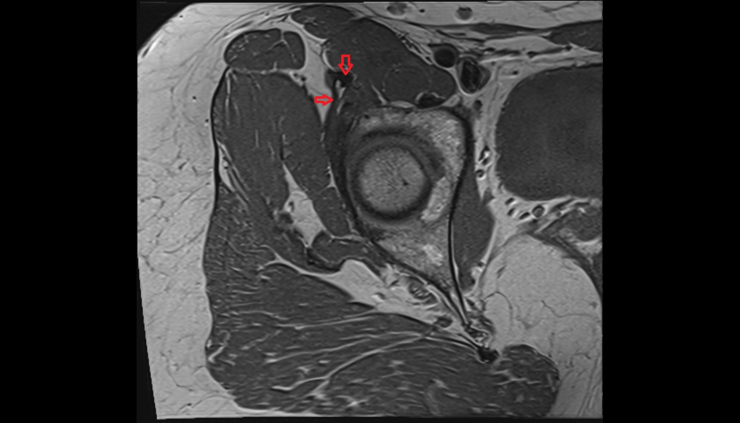 Rectus femoris tendon (Proximal tendon of rectus femoris)  MRI coronal anatomy image-img-00000-00000_00001