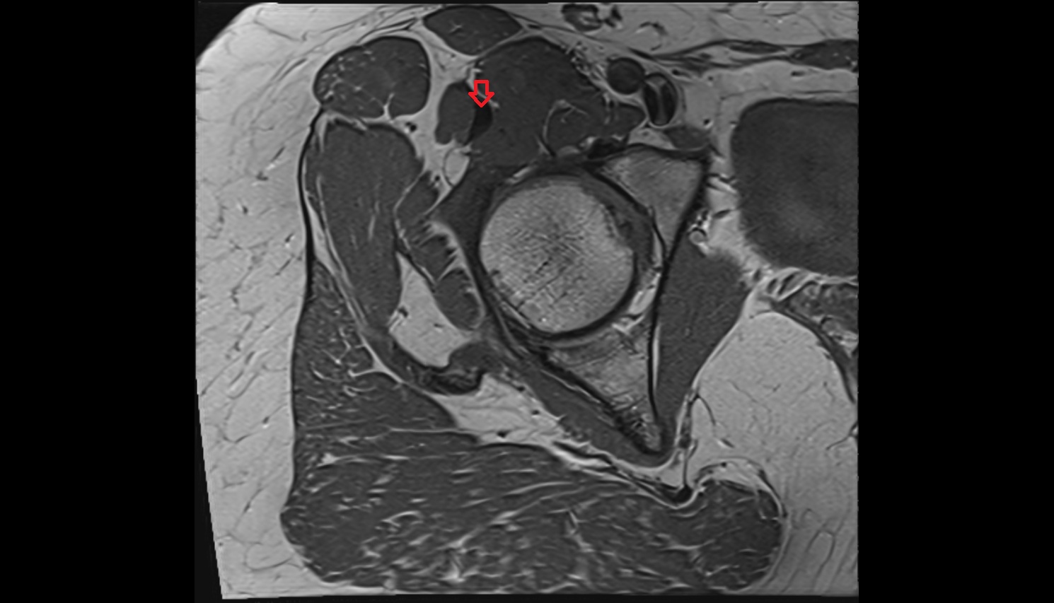 Rectus femoris tendon (Proximal tendon of rectus femoris)  MRI coronal anatomy image-img-00000-00000_00002