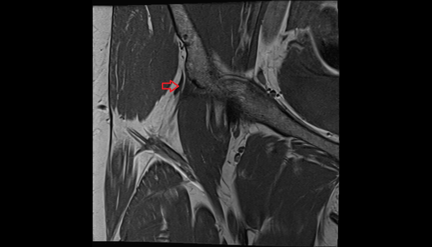 Rectus femoris tendon (Proximal tendon of rectus femoris)  MRI coronal anatomy image-img-00000-00000_00003