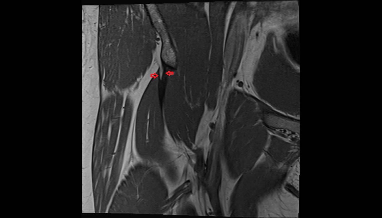 Rectus femoris tendon (Proximal tendon of rectus femoris)  MRI coronal anatomy image-img-00000-00000_00004